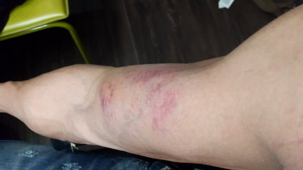 Sudheer babu injured in Baaghi film Fight Rehearsals-02